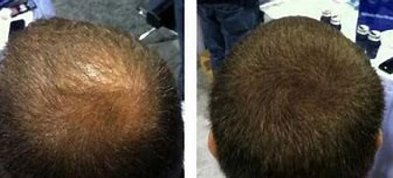 Targets Hair Loss & Vitamin Deficiencies for Men & Women