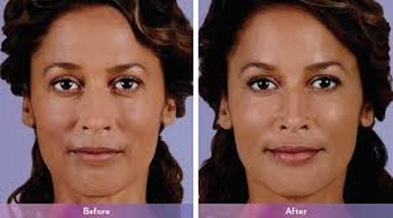 Authentic Dermal Fillers is a confided in online shop of stylish items and clini
